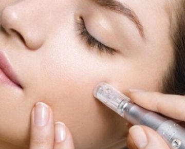 Microneedling